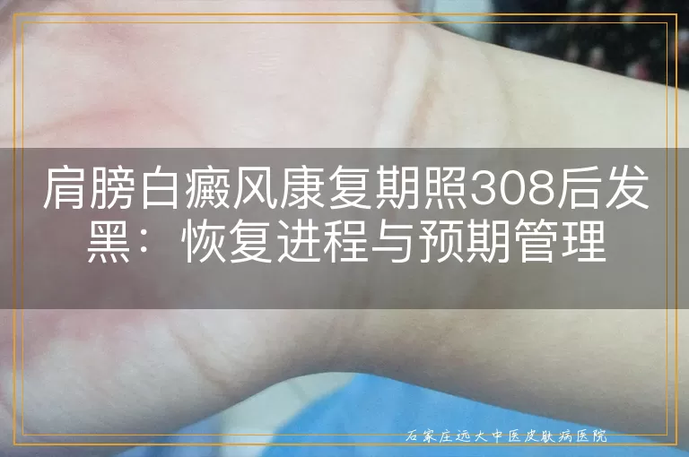 肩膀白癜风康复期照308后发黑：恢复进程与预期管理