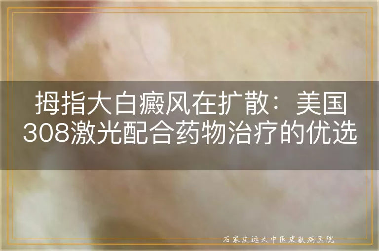 拇指大白癜风在扩散：美国308激光配合药物治疗的优选方案