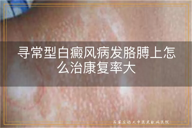 寻常型白癜风病发胳膊上怎么治康复率大