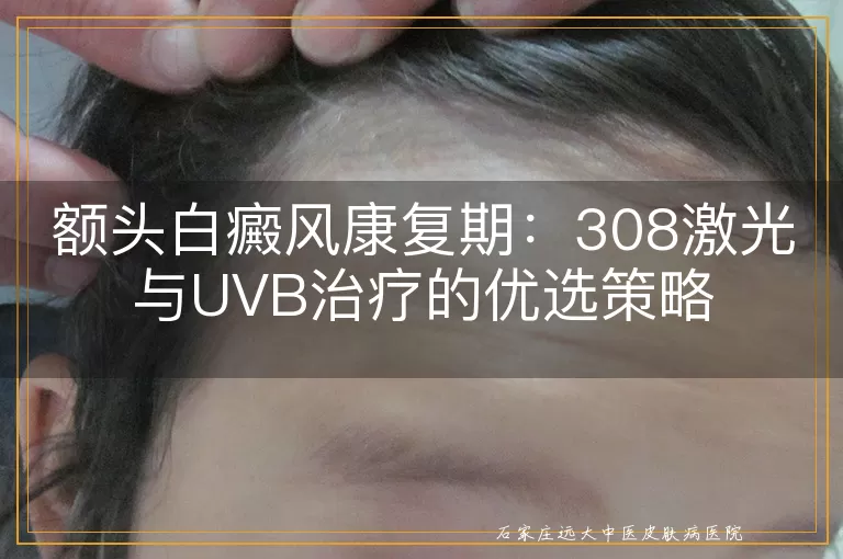 额头白癜风康复期：308激光与UVB治疗的优选策略