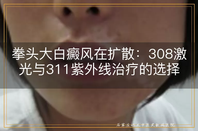 拳头大白癜风在扩散：308激光与311紫外线治疗的选择