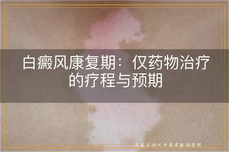 白癜风康复期：仅药物治疗的疗程与预期