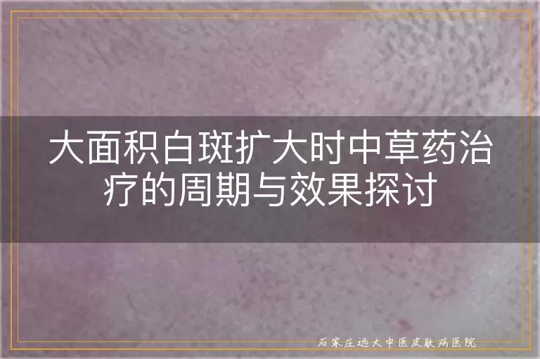 大面积白斑扩大时中草药治疗的周期与效果探讨