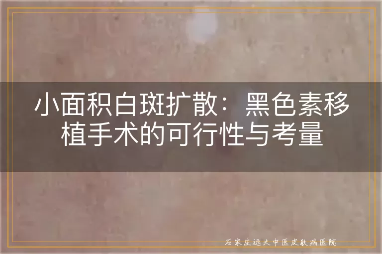 小面积白斑扩散：黑色素移植手术的可行性与考量