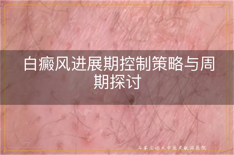 白癜风进展期控制策略与周期探讨