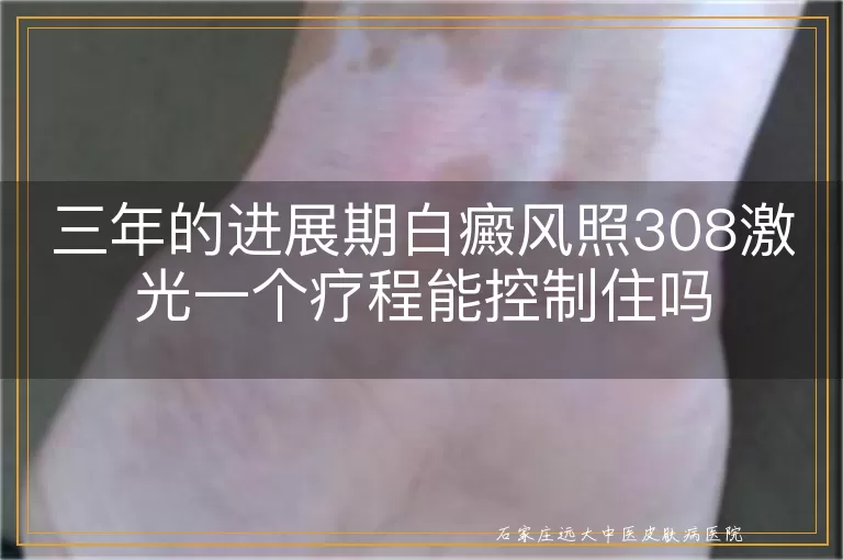 三年的进展期白癜风照308激光一个疗程能控制住吗