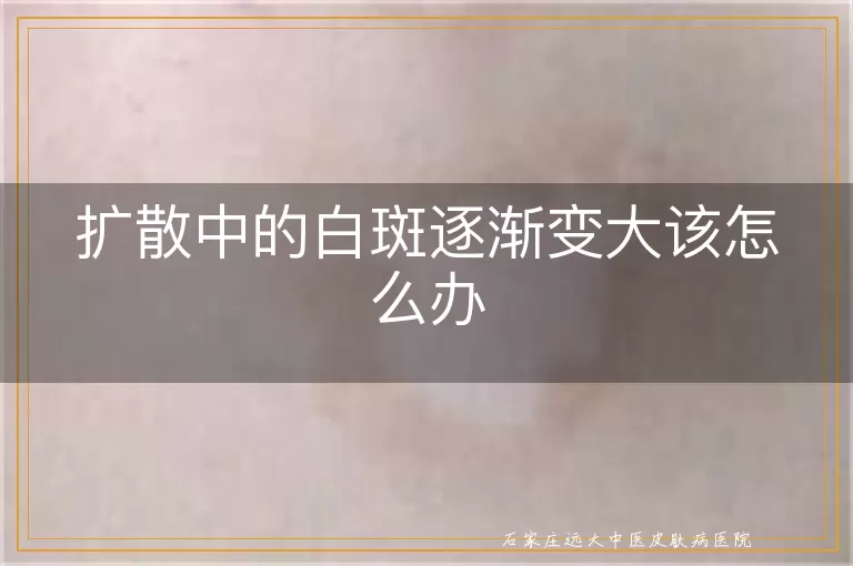 扩散中的白斑逐渐变大该怎么办