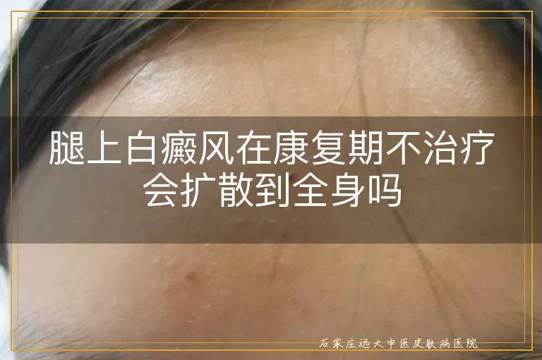 腿上白癜风在康复期不治疗会扩散到全身吗