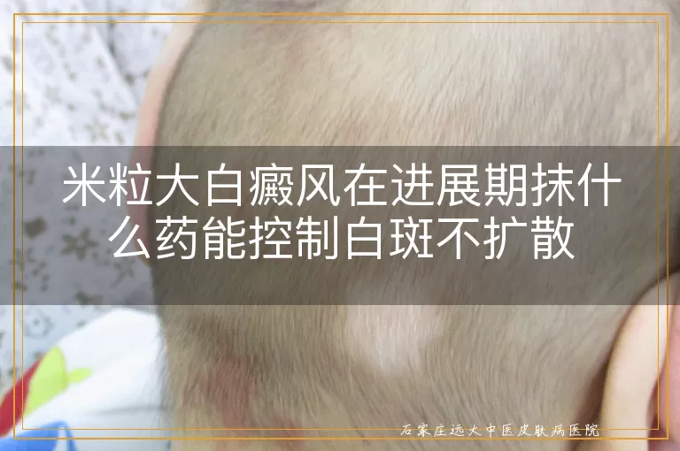 米粒大白癜风在进展期抹什么药能控制白斑不扩散