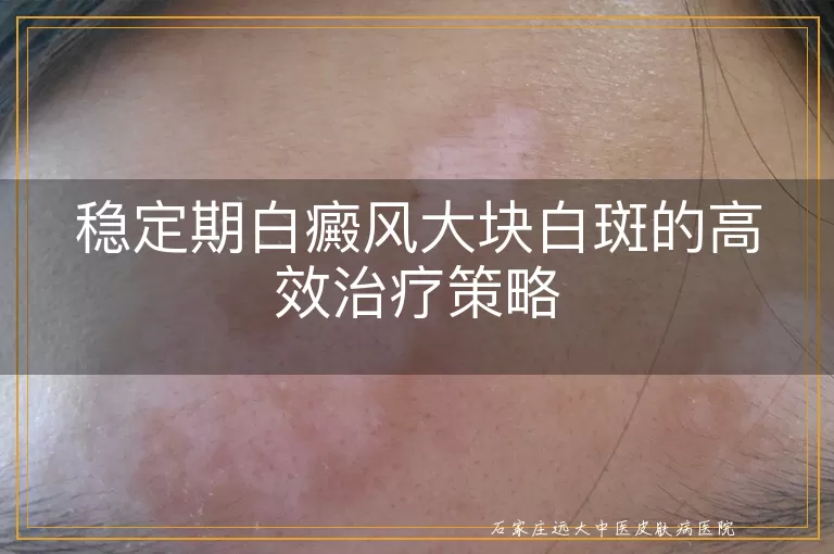 稳定期白癜风大块白斑的高效治疗策略