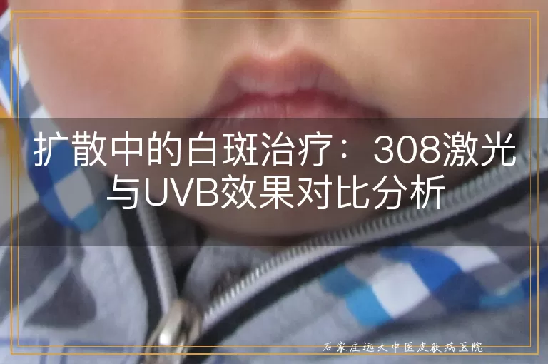 扩散中的白斑治疗：308激光与UVB效果对比分析