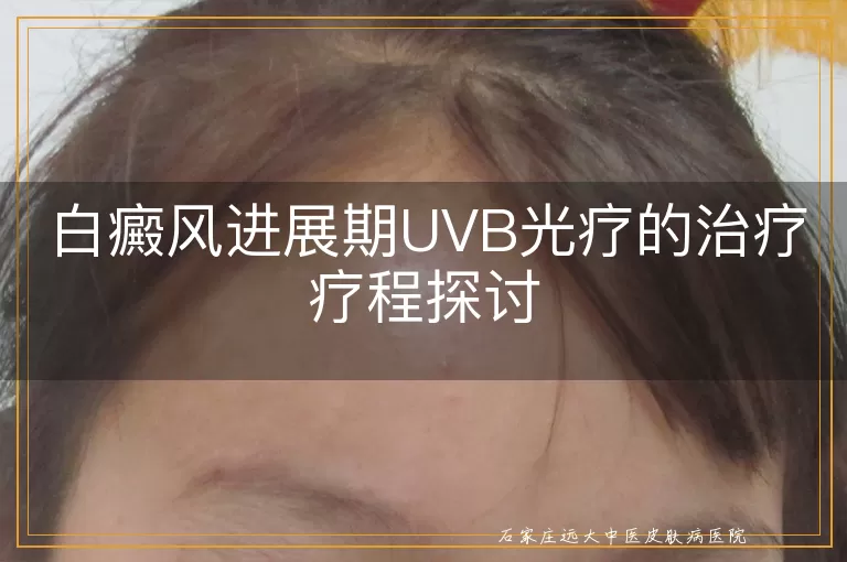 白癜风进展期UVB光疗的治疗疗程探讨