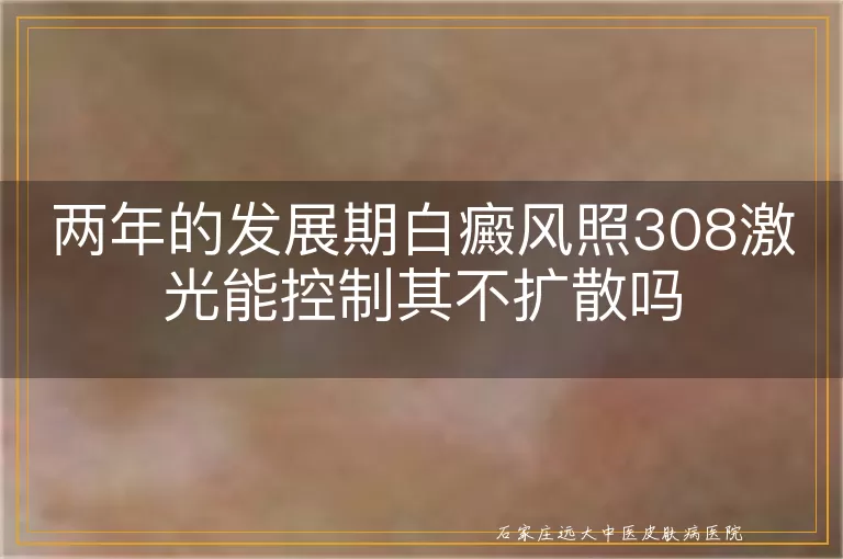 两年的发展期白癜风照308激光能控制其不扩散吗