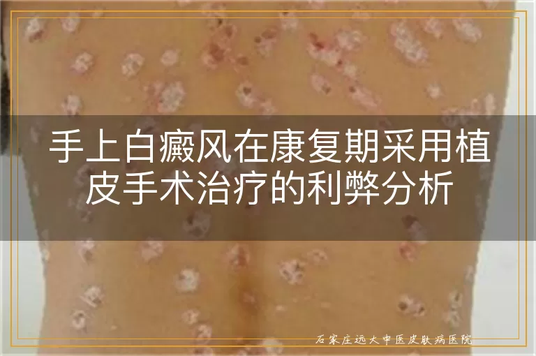 手上白癜风在康复期采用植皮手术治疗的利弊分析