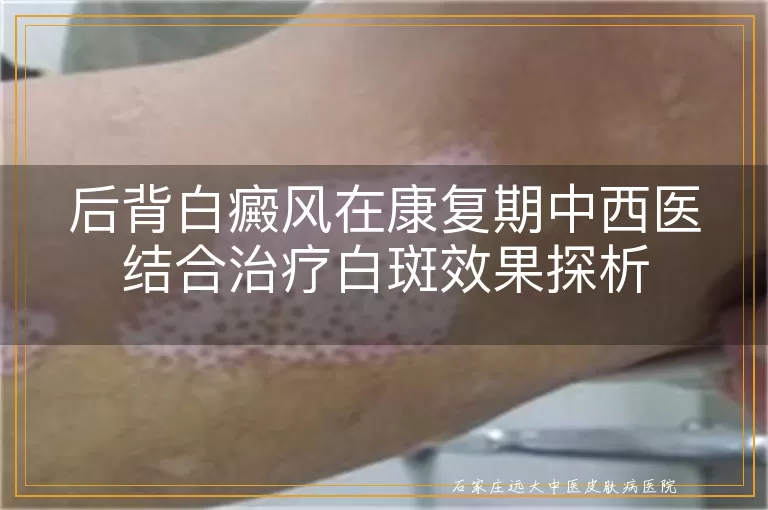 后背白癜风在康复期中西医结合治疗白斑效果探析
