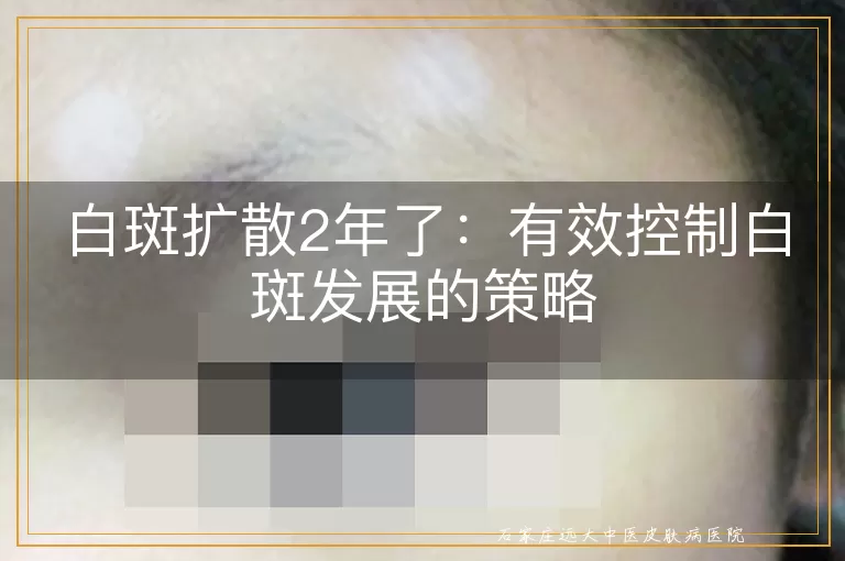 白斑扩散2年了：有效控制白斑发展的策略
