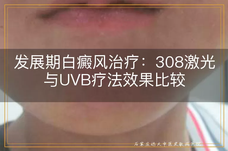 发展期白癜风治疗：308激光与UVB疗法效果比较
