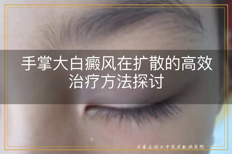 手掌大白癜风在扩散的高效治疗方法探讨