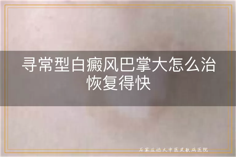 寻常型白癜风巴掌大怎么治恢复得快