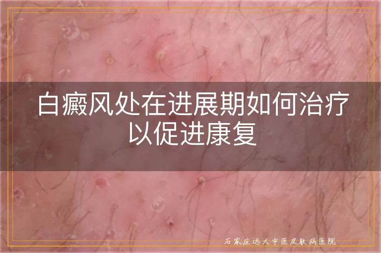 白癜风处在进展期如何治疗以促进康复