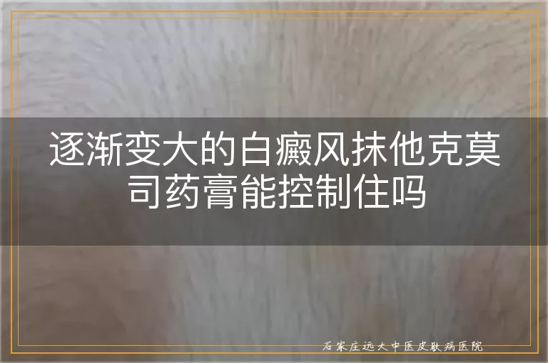 逐渐变大的白癜风抹他克莫司药膏能控制住吗