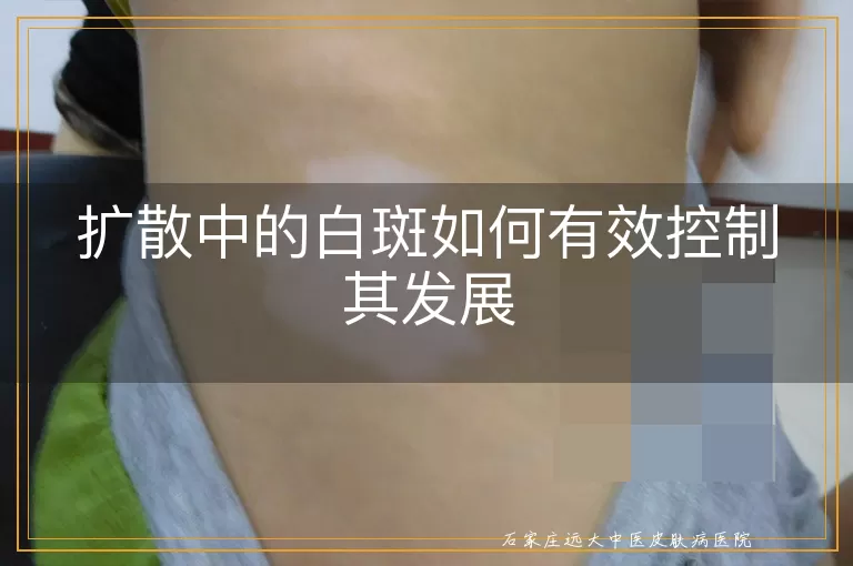 扩散中的白斑如何有效控制其发展