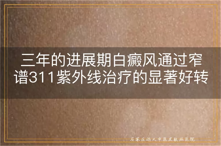 三年的进展期白癜风通过窄谱311紫外线治疗的显著好转案例