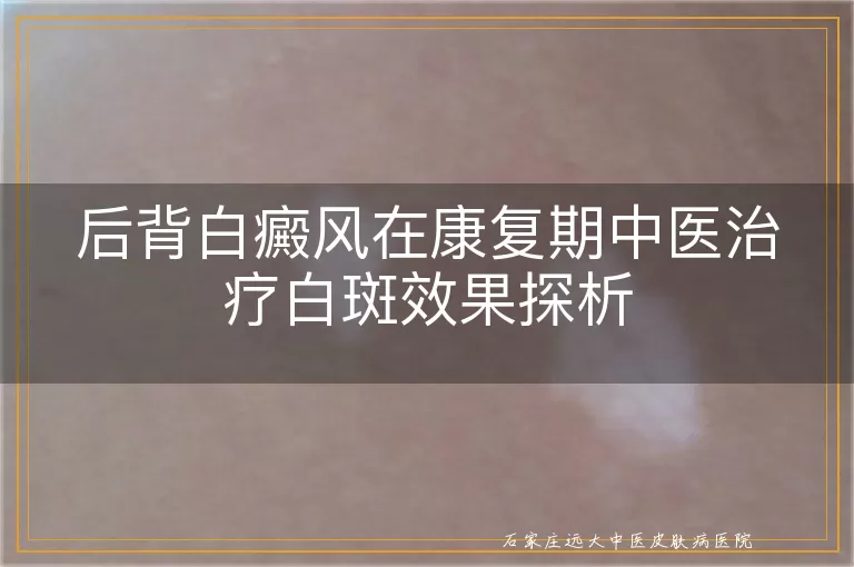 后背白癜风在康复期中医治疗白斑效果探析