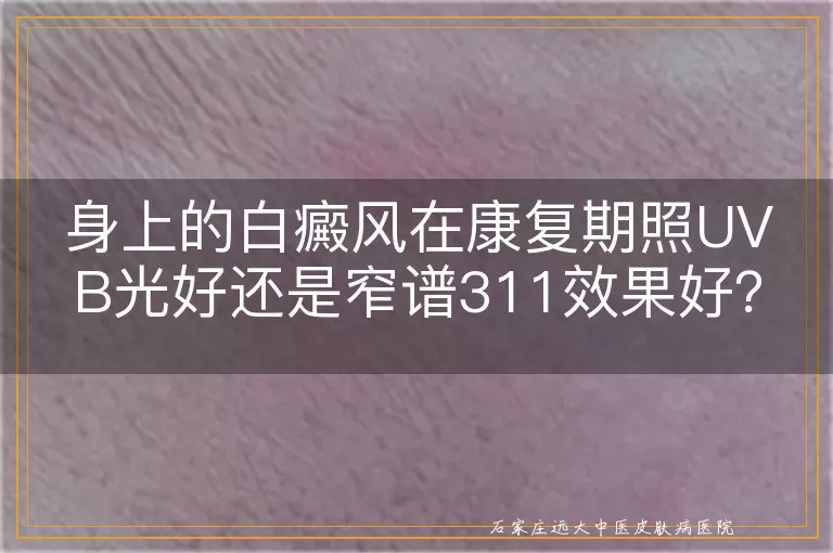 身上的白癜风在康复期照UVB光好还是窄谱311效果好？