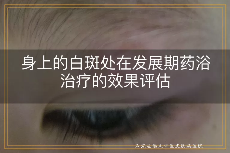 身上的白斑处在发展期药浴治疗的效果评估
