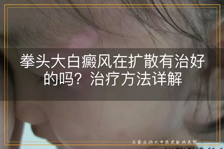 拳头大白癜风在扩散有治好的吗？治疗方法详解