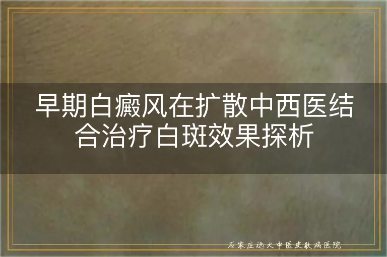早期白癜风在扩散中西医结合治疗白斑效果探析
