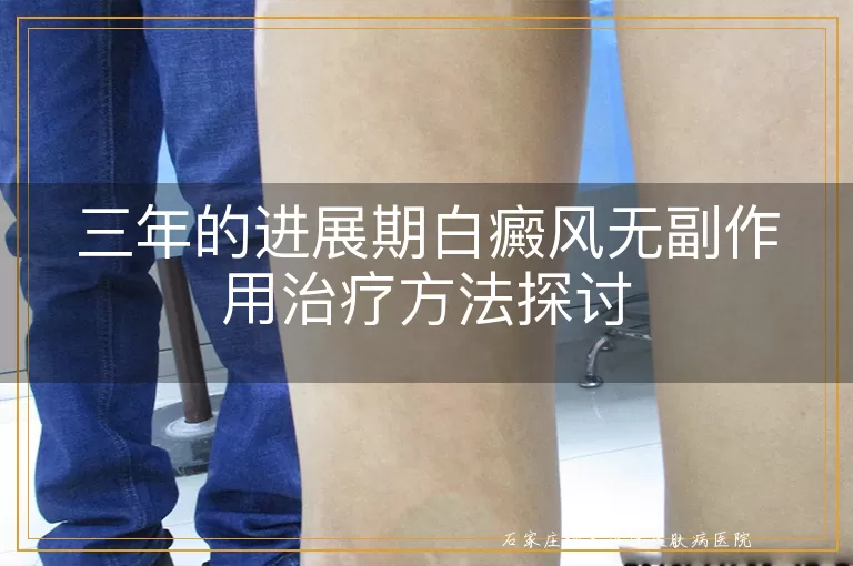 三年的进展期白癜风无副作用治疗方法探讨