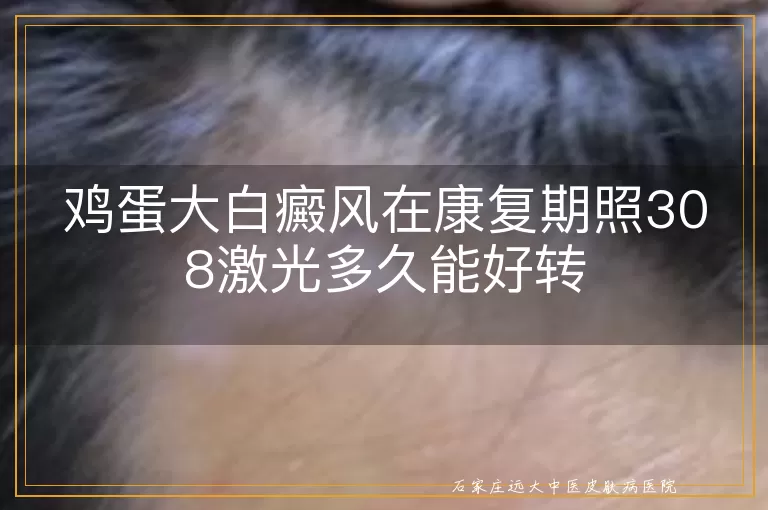 鸡蛋大白癜风在康复期照308激光多久能好转