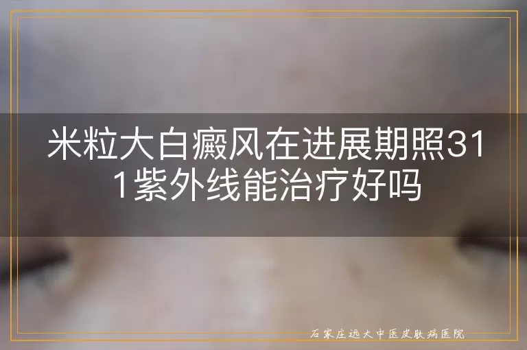米粒大白癜风在进展期照311紫外线能治疗好吗