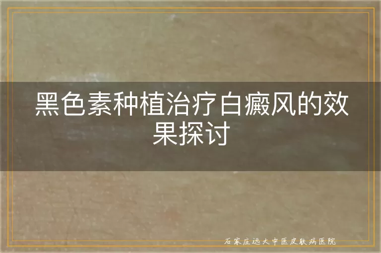 黑色素种植治疗白癜风的效果探讨