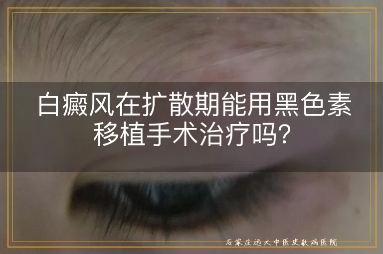 白癜风在扩散期能用黑色素移植手术治疗吗？