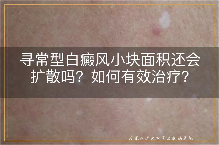 寻常型白癜风小块面积还会扩散吗？如何有效治疗？