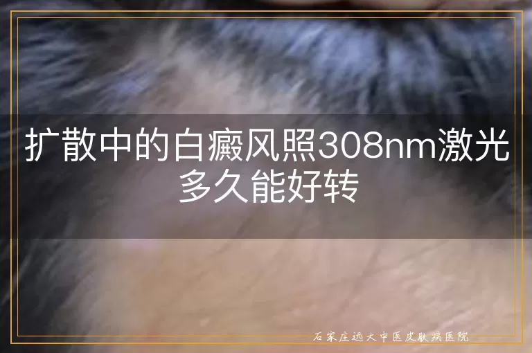 扩散中的白癜风照308nm激光多久能好转