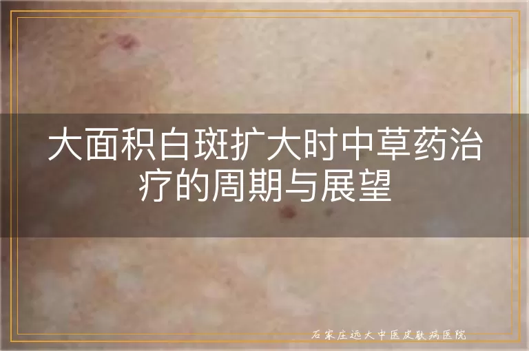 大面积白斑扩大时中草药治疗的周期与展望