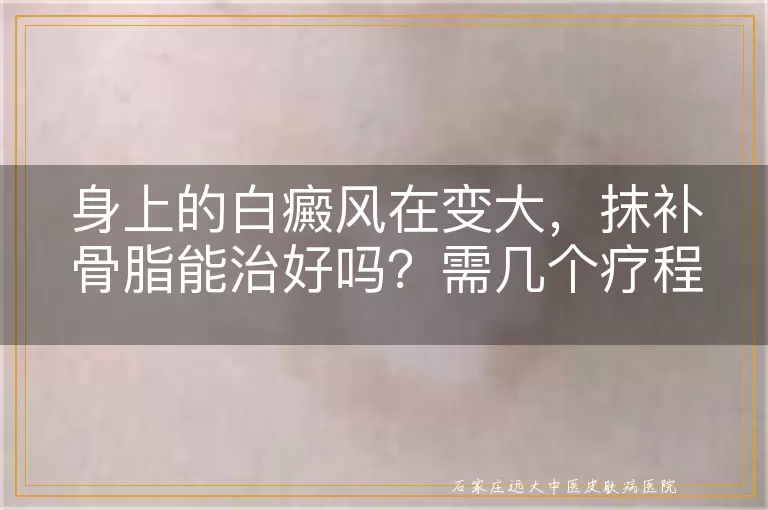 身上的白癜风在变大，抹补骨脂能治好吗？需几个疗程？