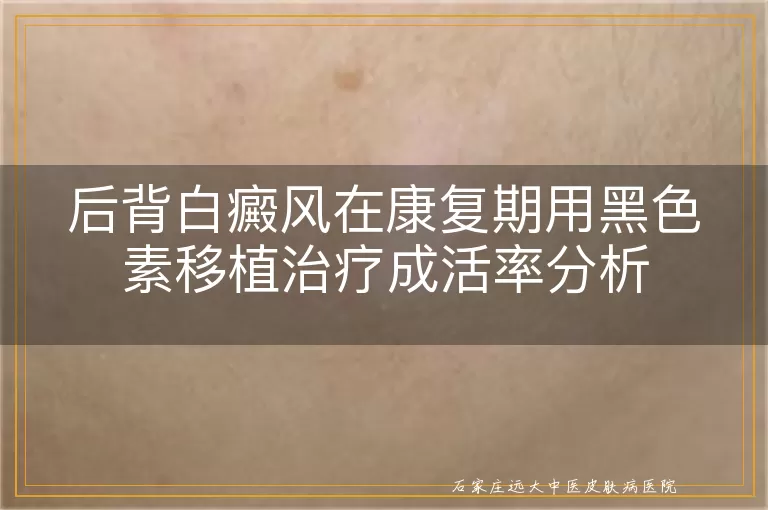 后背白癜风在康复期用黑色素移植治疗成活率分析