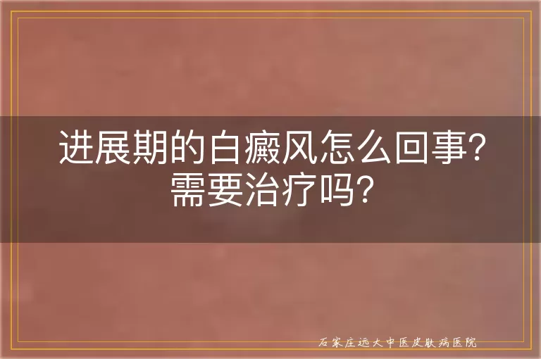 进展期的白癜风怎么回事？需要治疗吗？