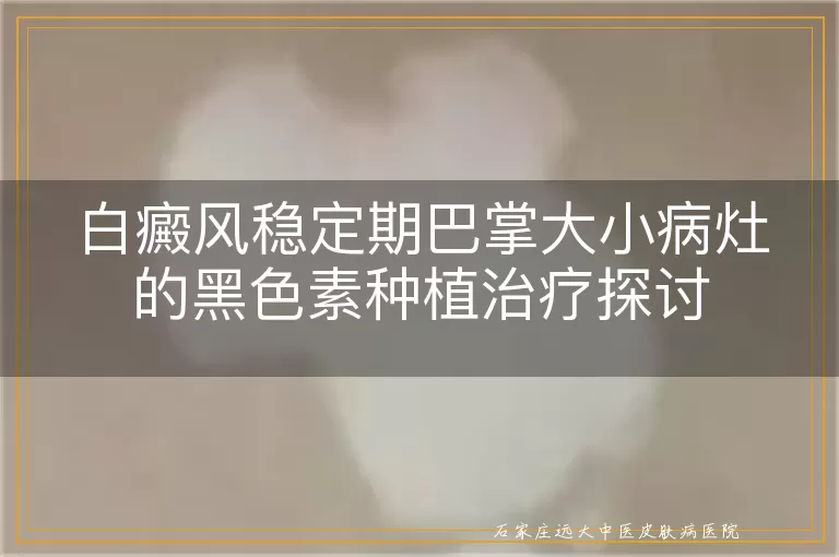 白癜风稳定期巴掌大小病灶的黑色素种植治疗探讨
