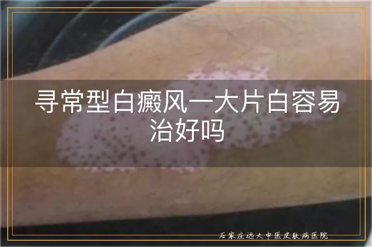 寻常型白癜风一大片白容易治好吗