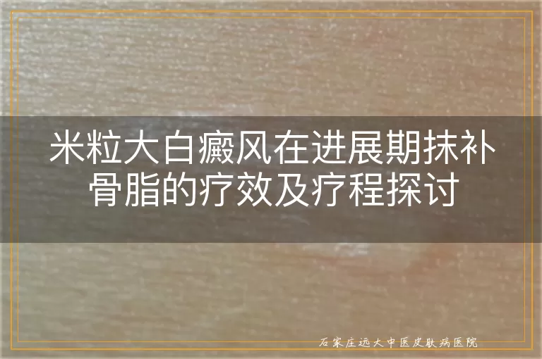 米粒大白癜风在进展期抹补骨脂的疗效及疗程探讨