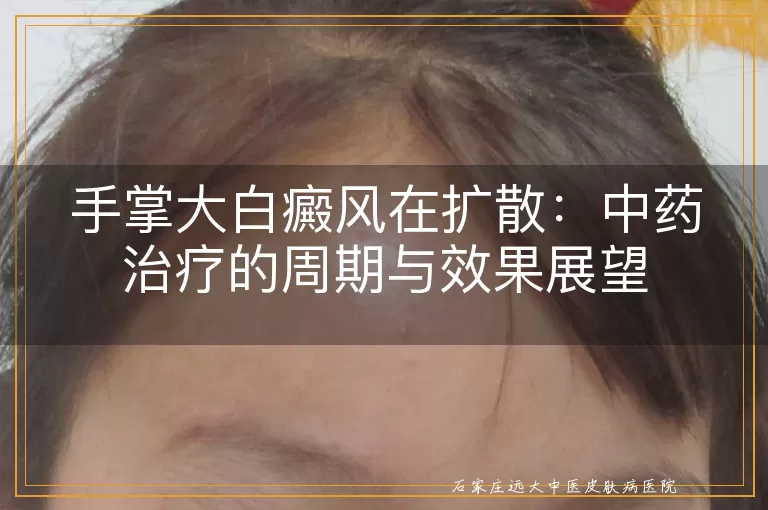手掌大白癜风在扩散：中药治疗的周期与效果展望