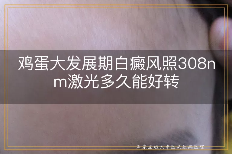 鸡蛋大发展期白癜风照308nm激光多久能好转