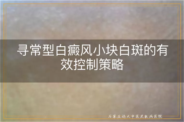 寻常型白癜风小块白斑的有效控制策略