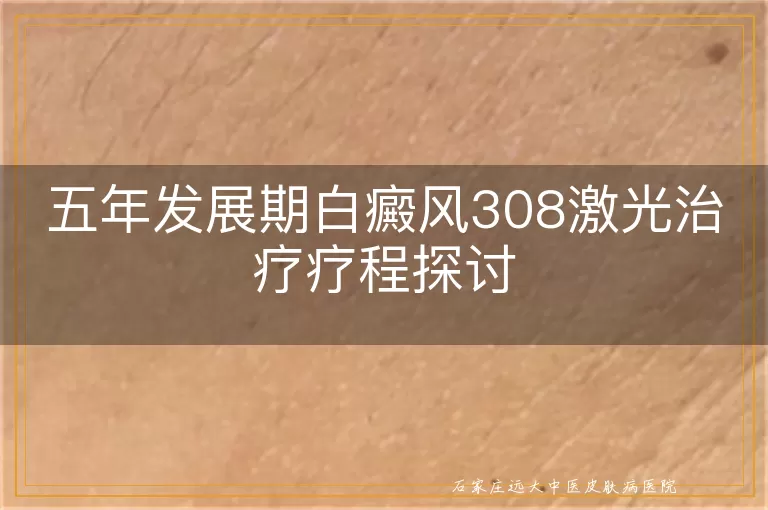五年发展期白癜风308激光治疗疗程探讨